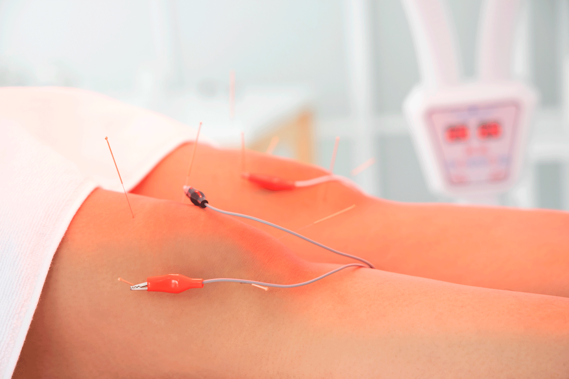 Fisioterapia Palencia electrolisis percutánea terapéutica Clínica Marta Perrote